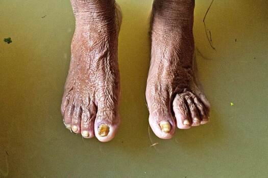 Banshkhali Upazila Chittagong Division Bangladesh 10 July 2026 View of the weathered feet of an elderly person standing in murky floodwater. Banshkhali Upazila Chittagong Division Bangladesh 10 July 2026 View of the weathered feet of an elderly person standing in murky floodwater.