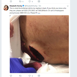 Actress Elizabeth Hurley posts an image of the damage caused to her nephew in a knife attack.
