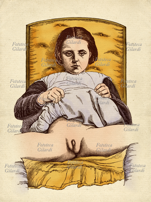 MEDICINA Incisione ottocentesca raffigurante giovane ermafrodita adolescente di 13 anni. Italia XIX secolo