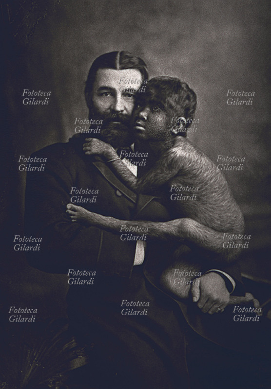 MEDICINA Londra 1883. In braccio al Prof. Carl Bock la piccola Kao. Nata a Bangkok, nel Siam, da genitori schiavi di cui il padre normale e la madre come lei affetta da ipetricosi. Fu uno degli argomenti viventi dei darwiniani, fu esposta a Londra nel gennaio 1883 come il \