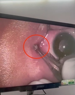 Boy three has WORM removed from his eye after it crawled inside Boy three has WORM removed from his eye after it crawled inside