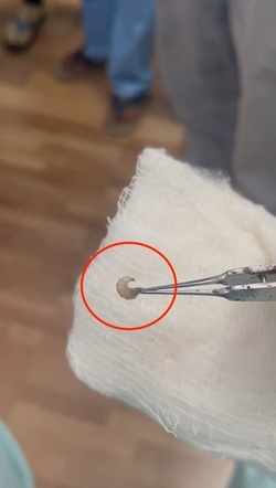 Boy three has WORM removed from his eye after it crawled inside Boy three has WORM removed from his eye after it crawled inside