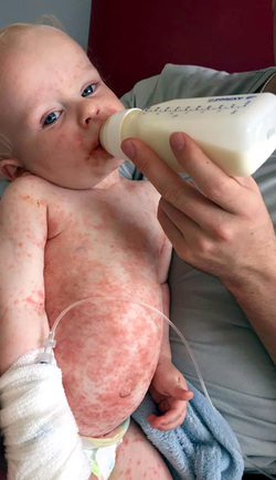 MOTHER SPEAKS OUT AFTER HER SON CONTRACTED THE HERPES VIRUS THROUGH A KISS