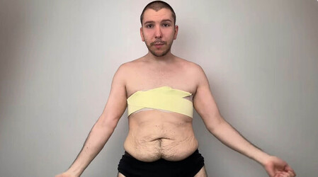 Nikocado Avocado reveals he had 10 lbs. of loose skin removed Nikocado Avocado reveals he had 10 lbs. of loose skin removed