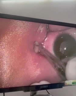 Boy three has WORM removed from his eye after it crawled inside Boy three has WORM removed from his eye after it crawled inside