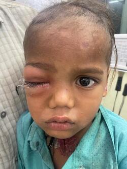 Boy three has WORM removed from his eye after it crawled inside Boy three has WORM removed from his eye after it crawled inside