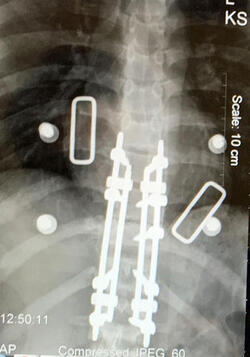 LUCKY TO BE ALIVE TEEN LEFT PARALYSED FROM A 135KPH MOTORCYLE ACCIDENT DEFIES THE ODDS TO WALK AND NOW PLANS DARING ACTIVITIES