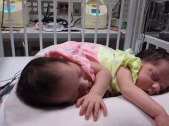 Conjoined Twins Defied Odds By Taking First Step And Living Their Best Life Conjoined Twins Defied Odds By Taking First Step And Living Their Best Life