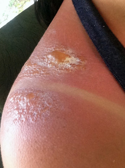 ALICE RING PSORIASIS
