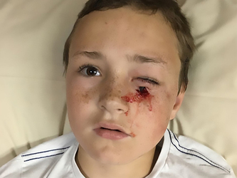 Docs Save Sight Of Boy 8 After Horrific Freak Accident