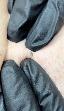 Blackhead removal video equally disgusts and satisfies users