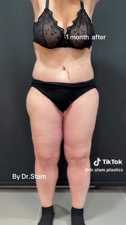 VIDEO Plastic surgeon reveals extreme tummy tuck transformations as viewers marvel at results