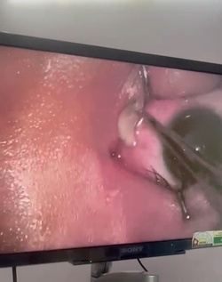 Boy three has WORM removed from his eye after it crawled inside Boy three has WORM removed from his eye after it crawled inside