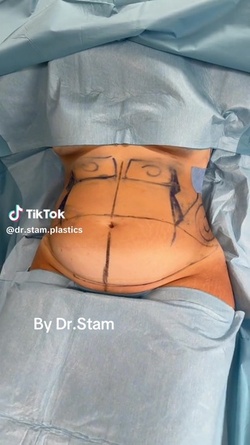 VIDEO Plastic surgeon reveals extreme tummy tuck transformations as viewers marvel at results