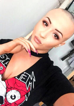 STUNNING ALOPECIA SUFFERER FINALLY BARES ALL DESPITE BULLIES ATTEMPTS TO SET HER WIG ON FIRE STUNNING ALOPECIA SUFFERER FINALLY BARES ALL DESPITE BULLIES ATTEMPTS TO SET HER WIG ON FIRE