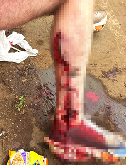 VIDEO Brit holidaymaker has leg sliced open and broken in horror crash with scooter while out jogging