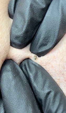 Blackhead removal video equally disgusts and satisfies users