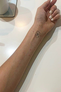 AIR HOSTESS COMPARED TO BURNS VICTIM AFTER SEVERE PSORIASIS FLARE UP SHOWCASES CLEAR SKIN AFTER SWITCHING DIET