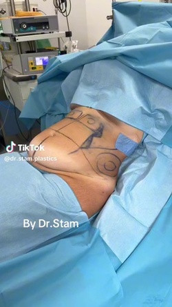 VIDEO Plastic surgeon reveals extreme tummy tuck transformations as viewers marvel at results