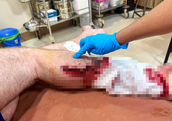 VIDEO Brit holidaymaker has leg sliced open and broken in horror crash with scooter while out jogging