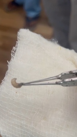 Boy three has WORM removed from his eye after it crawled inside Boy three has WORM removed from his eye after it crawled inside