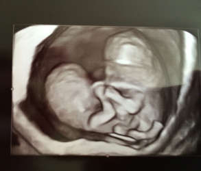 Conjoined Twins Defied Odds By Taking First Step And Living Their Best Life Conjoined Twins Defied Odds By Taking First Step And Living Their Best Life