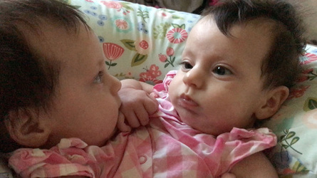 Conjoined Twins Defied Odds By Taking First Step And Living Their Best Life Conjoined Twins Defied Odds By Taking First Step And Living Their Best Life