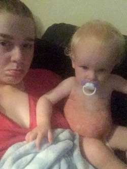 MOTHER SPEAKS OUT AFTER HER SON CONTRACTED THE HERPES VIRUS THROUGH A KISS
