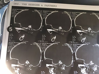 Docs Save Sight Of Boy 8 After Horrific Freak Accident