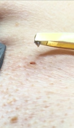 Blackhead removal video equally disgusts and satisfies users