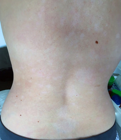 ALICE RING PSORIASIS