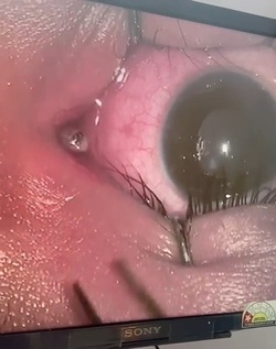 Boy three has WORM removed from his eye after it crawled inside Boy three has WORM removed from his eye after it crawled inside