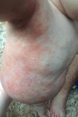 MOTHER SPEAKS OUT AFTER HER SON CONTRACTED THE HERPES VIRUS THROUGH A KISS