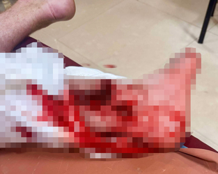 VIDEO Brit holidaymaker has leg sliced open and broken in horror crash with scooter while out jogging