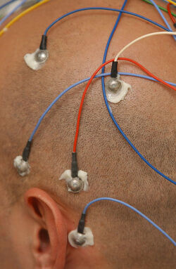 Epilessia